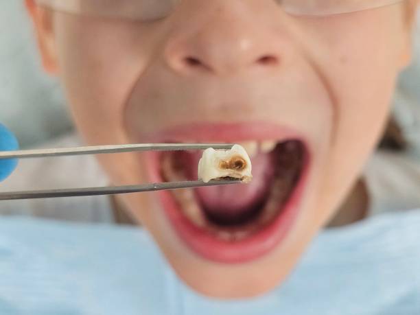 Best Dentist for Tooth Abscess  in Indian Wells, CA